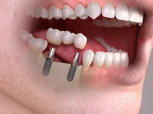 ترمیم چندین دندان از دست رفته با ایمپلنت: زیبایی و عملکرد طبیعی